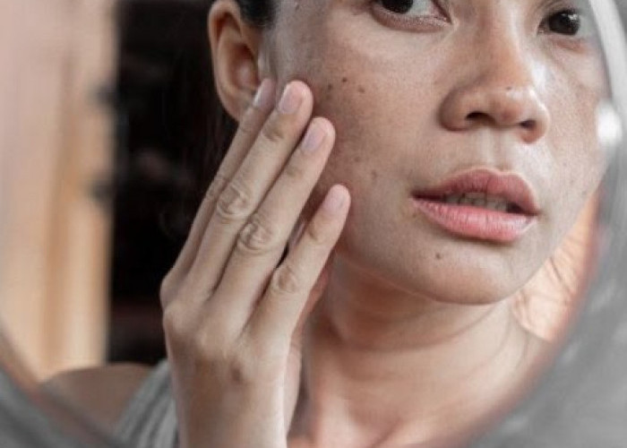 Perlu Tahu! Penyebab Flek Hitam di Wajah, Bukan Cuma karena Sinar Matahari