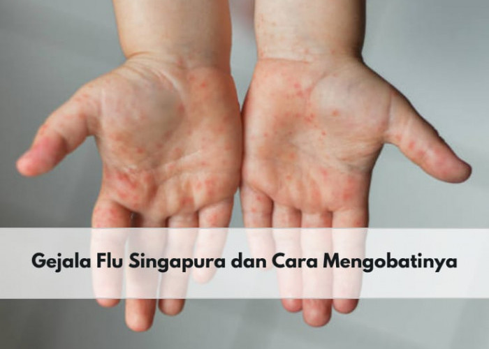 Sedang Marak Terjadi, Segera Ketahui Gejala Flu Singapura dan Cara Mengobatinya di Sini