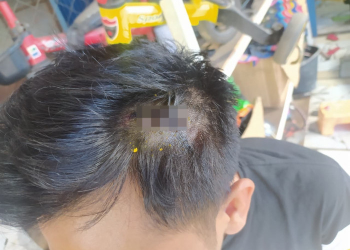 Dikroyok Menggunakan Sajam, Warga Singgaran Pati Alami Luka Robek di Kepala