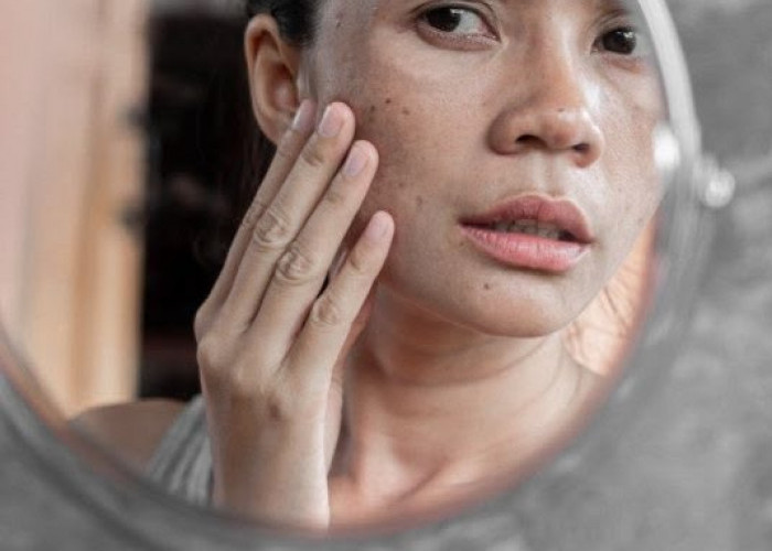 Cek di Sini! Cara Alami Mengatasi Flek Hitam, Bisa Dilakukan dengan Perawatan Sederhana
