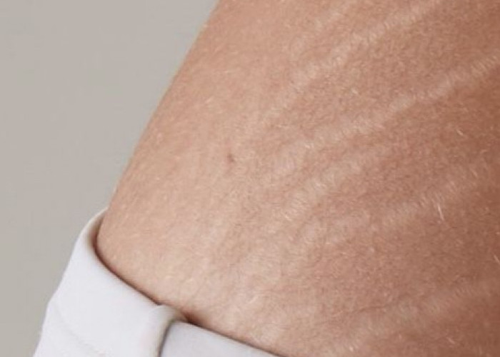 Ini Cara Mengatasi Stretch Mark pada Kulit, Bantu Menyamarkan Bekas Garis di Tubuh