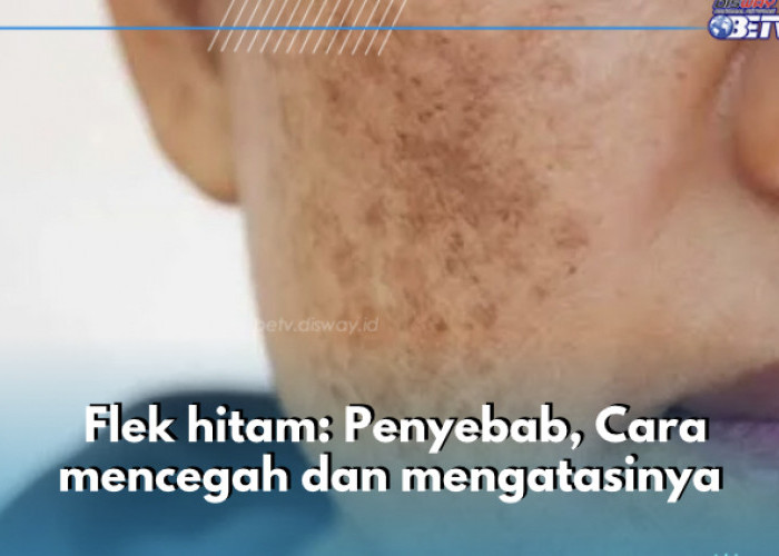 Flek Hitam di Wajah: Penyebab, Cara Mencegah dan Mengatasinya