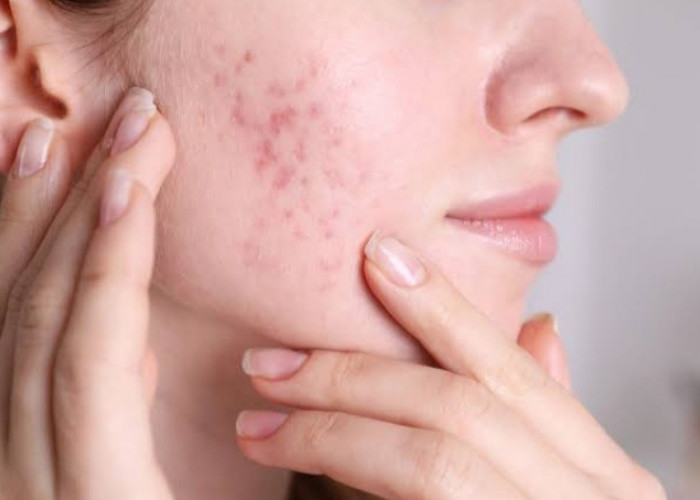 Ini 5 Rekomendasi Produk Sunscreen untuk Atasi Kulit Berjerawat, Ada Azarine hingga Skintific