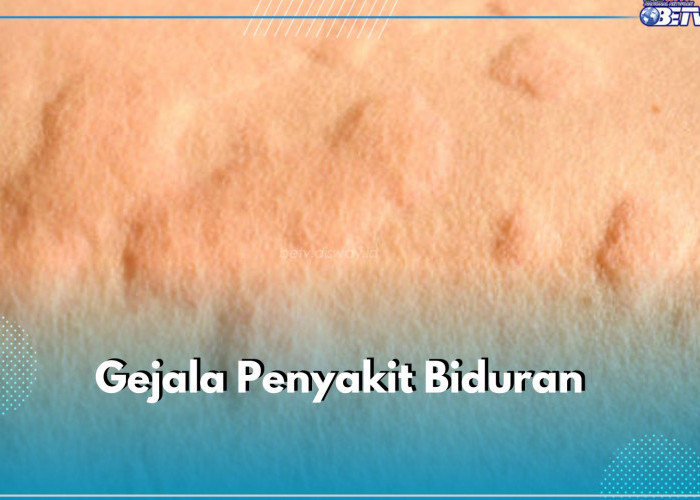 Bukan Cuma Bentol, Ini 5 Gejala Penyakit Biduran yang Perlu Kamu Ketahui