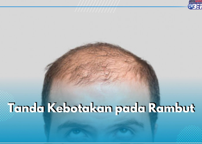 Wajib Tahu! Ini 7 Tanda Kebotakan pada Rambut, Atasi Sebelum Terlambat