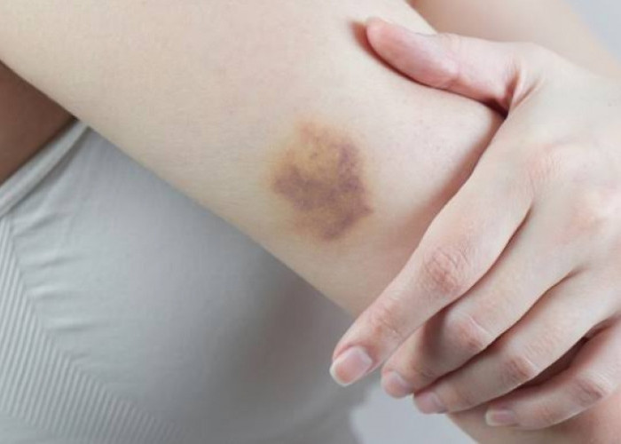 Terbukti Ampuh! Cek Disini Pilihan Obat Memar dengan Bahan Herbal Alami