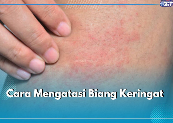 Sering Alami Biang Keringat? Segera Atasi dengan 6 Cara Mudah Ini, Gunakan Kompres Dingin hingga Obat