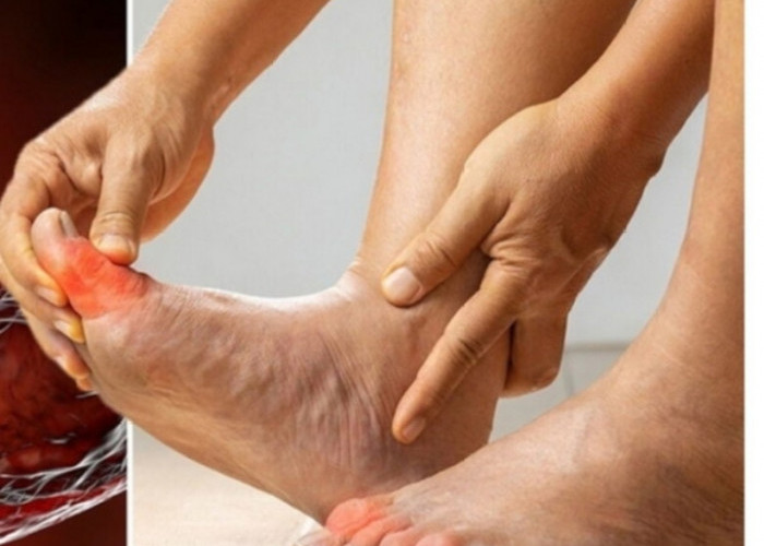 Kaki Terasa Nyeri? Waspada Ciri-ciri Kolesterol Tinggi, Ini Penjelasannya!