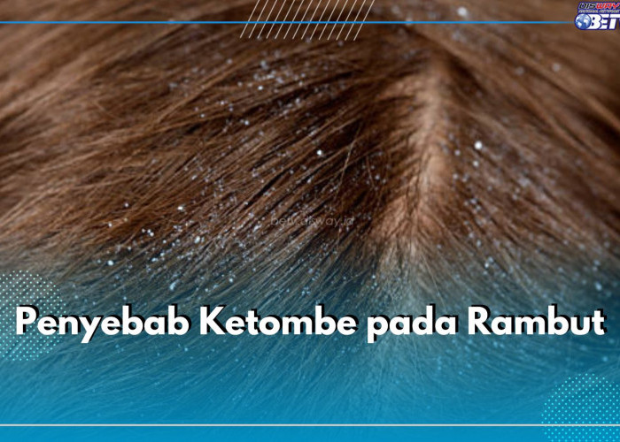 Kenali 5 Penyebab Ketombe Pada Rambut Ini, Salah Satunya Jarang Keramas