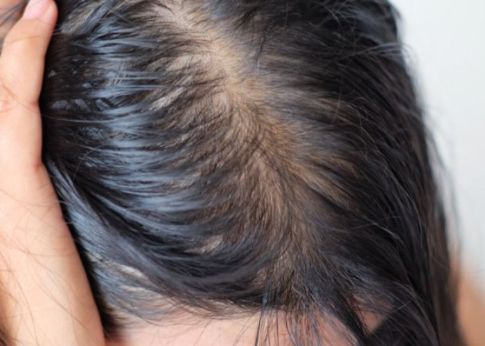 Ini Cara Mengatasi Kulit Kepala Berminyak, Rambut Tetap Segar dan Tidak Mudah Lepek
