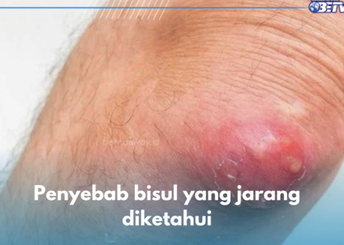 8 Penyebab Bisul yang Jarang Deketahui, Telur Termasuk? Cek di Sini