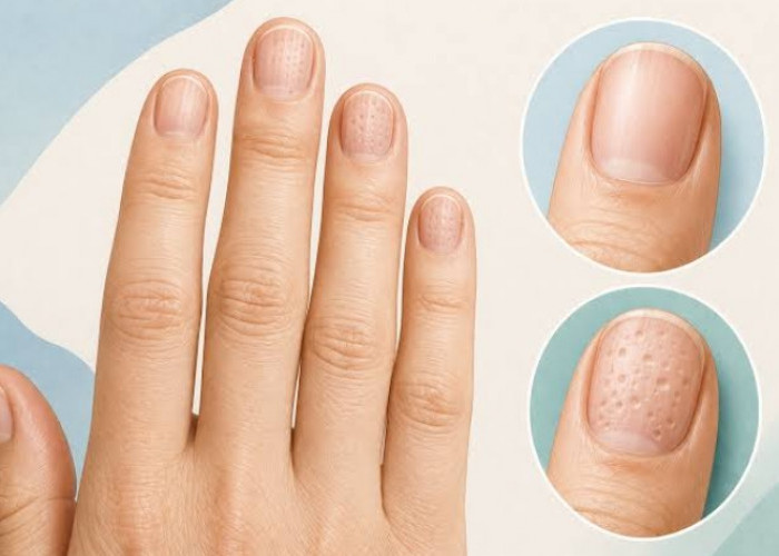 Kuku Miliki Beragam Jenis Penyakit yang Jarang Diketahui, Ada Nail Pitting hingga Garis Beau