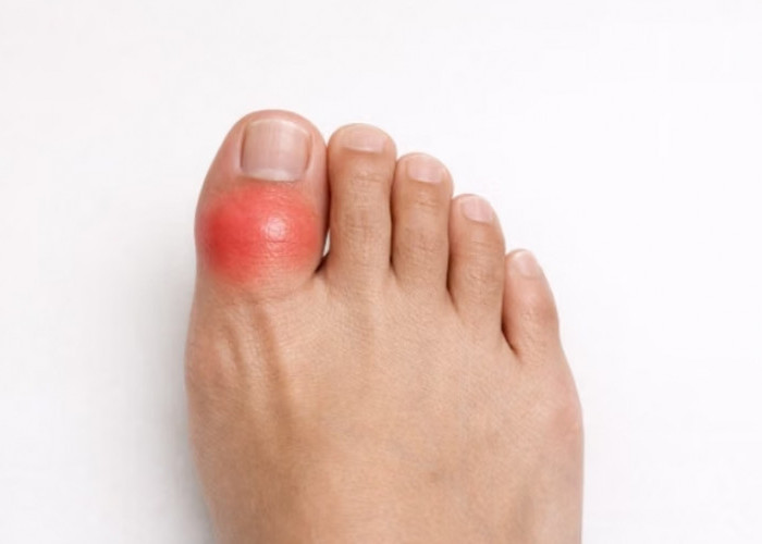 Nyeri pada Jempol Kaki Bisa Jadi Tanda Asam Urat, Cek Lainnya Disini!