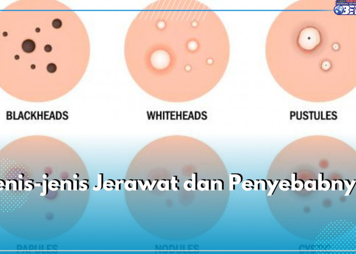 Ketahui Jenis-jenis Jerawat Ini dan Singkap Penyebabnya, Ada Jerawat Komedo hingga Jerawat Nodul