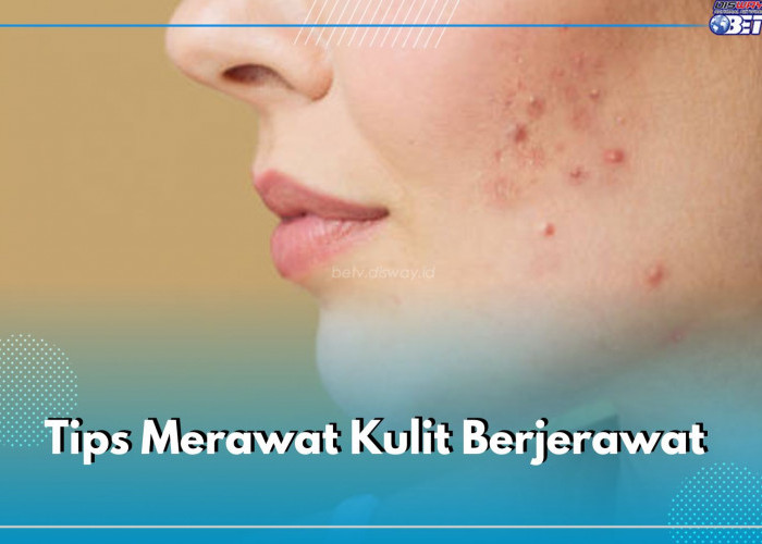 Ini 5 Tips Merawat Kulit Berjerawat Agar Tidak Semakin Banyak, Mulai dari Mencuci Muka Hingga Mengelola Stress