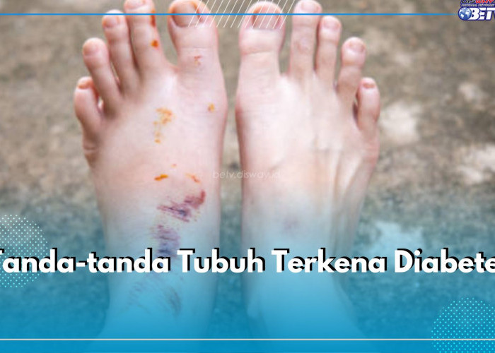 Punya Luka Tapi Susah Kering? Bisa Jadi Terkena Diabetes, Cek Tanda-tanda Lainnya di Sini