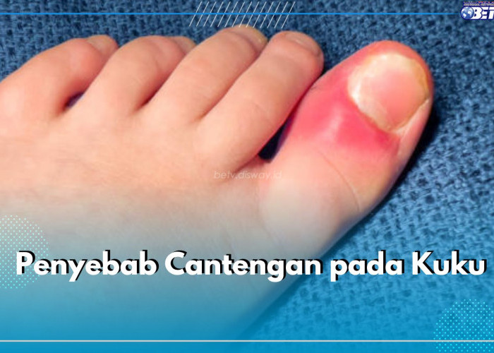 Cara Potong Kuku yang Salah Bisa Bikin Cantengan, Cek 5 Penyebab Lainnya di Sini!