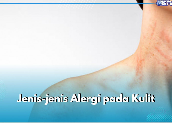 Dermatitis Kontak hingga Eksim, Ini 5 Jenis Alergi pada Kulit yang Perlu Kamu Ketahui