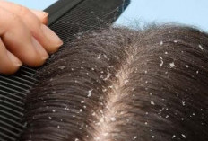 Perlu Tahu! Penyebab Rambut Mudah Ketombean, Salah Satunya Karena Kulit Kepala Berminyak 