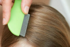 Efektif, Cara Menghilangkan Kutu Rambut yang Jarang Diketahui, Membantu Mencegah Datang Kembali