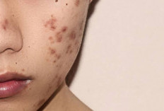Susah Hilangkan Bekas Jerawat Hitam Dipipi? Coba Gunakan 3 Rekomendasi Masker Ini!