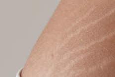 Ini Cara Mengatasi Stretch Mark pada Kulit, Bisa Tampak Lebih Halus