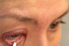 Cek Disini! Rekomendasi Salep untuk Atasi Mata Bintitan