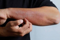 Kulit Kering Bisa Diatasi dengan Makanan Tinggi Kandungan Vitamin, Cek Daftarnya Disini!