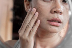 Perlu Tahu! Penyebab Flek Hitam di Wajah, Bukan Cuma karena Sinar Matahari
