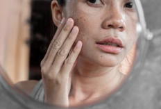 Cek di Sini! Cara Alami Mengatasi Flek Hitam, Bisa Dilakukan dengan Perawatan Sederhana