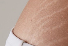 Ini Cara Mengatasi Stretch Mark pada Kulit, Bantu Menyamarkan Bekas Garis di Tubuh