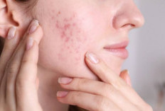Ini 5 Rekomendasi Produk Sunscreen untuk Atasi Kulit Berjerawat, Ada Azarine hingga Skintific