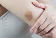 Terbukti Ampuh! Cek Disini Pilihan Obat Memar dengan Bahan Herbal Alami