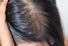 Ini Cara Mengatasi Kulit Kepala Berminyak, Rambut Tetap Segar dan Tidak Mudah Lepek