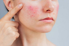 Muka Beruntusan Susah Diatasi? Coba Gunakan 5 Bahan Alami Ini, Salah Satunya Masker Teh Hijau