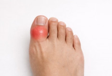 Nyeri pada Jempol Kaki Bisa Jadi Tanda Asam Urat, Cek Lainnya Disini!